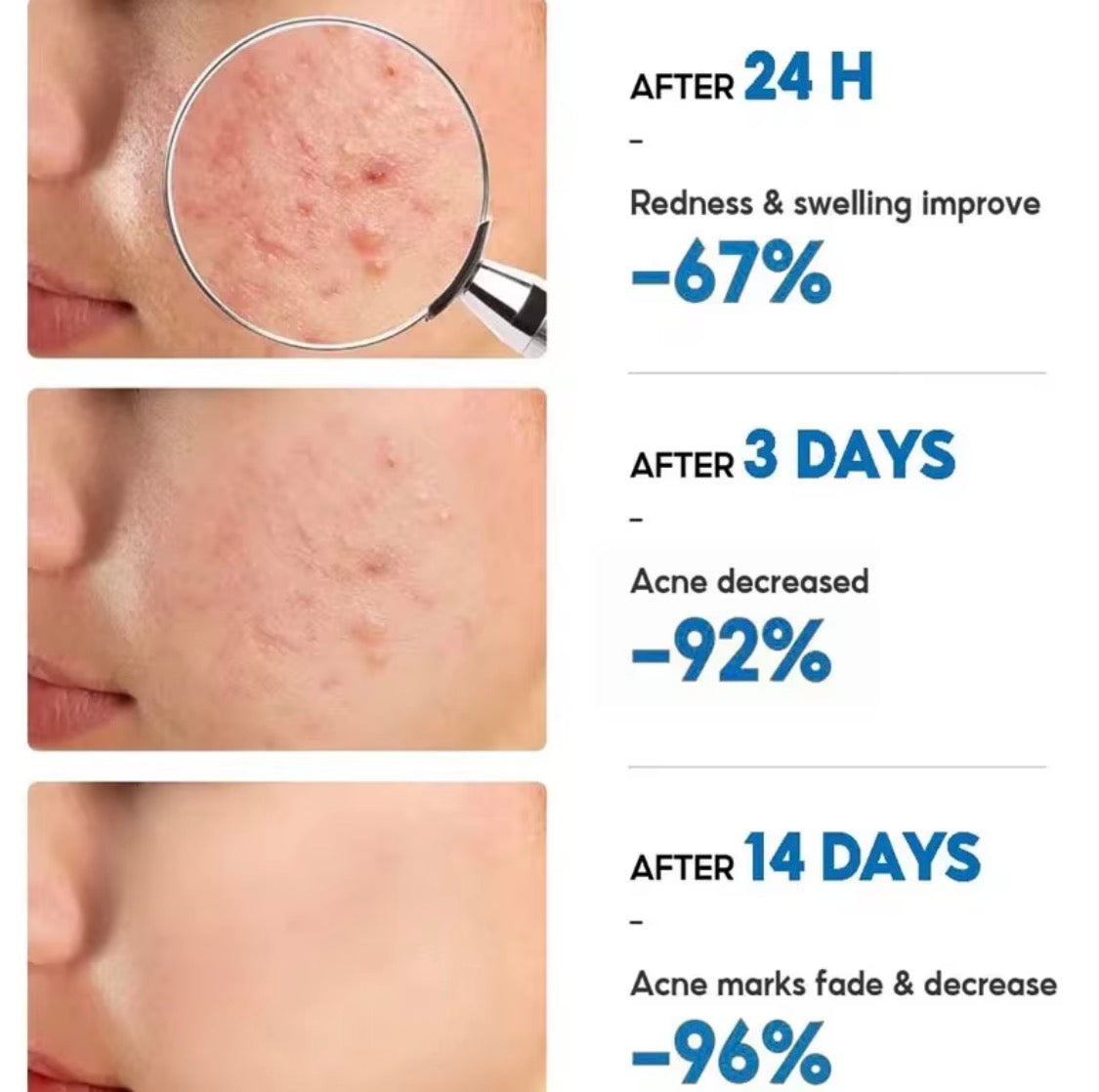 Salicylic Acid Acne Cream – Anti-Acne, Redness & Pore Care [3 PACK]