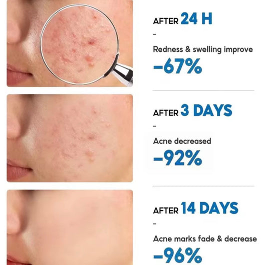 Salicylic Acid Acne Cream – Anti-Acne, Redness & Pore Care [3 PACK]